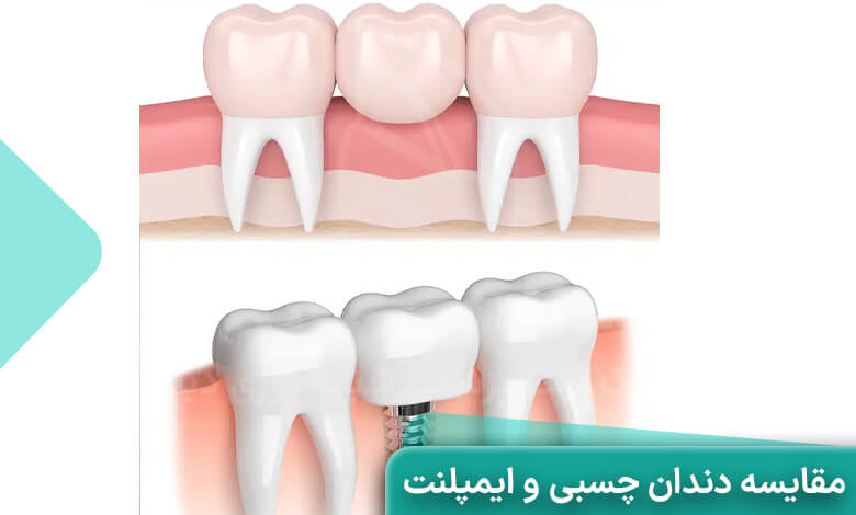 مقایسه دندان چسبی و ایمپلنت