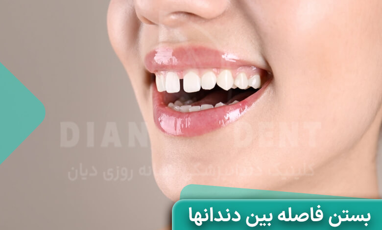 فاصله بین دندان ها چه مشکلاتی ایجاد میکند.