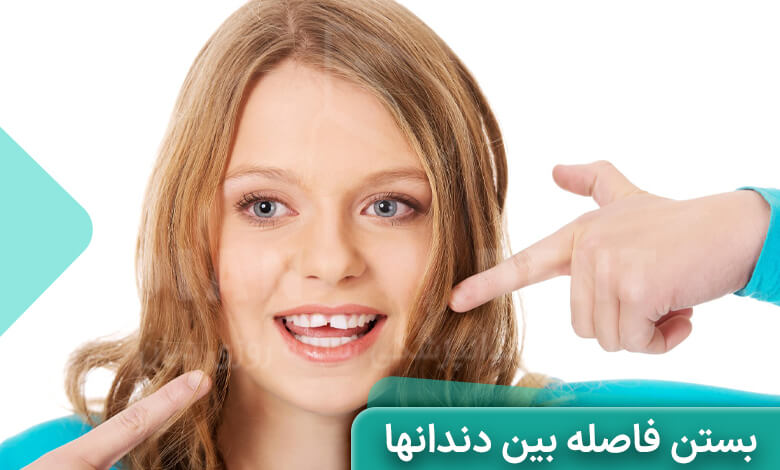 روش های بستن فاصله بین دندان ها بدون ارتودنسی