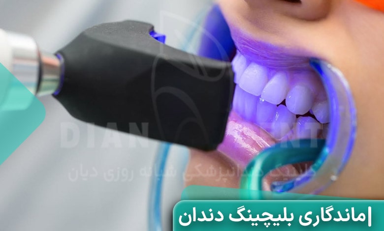 ماندگاری بلیچینگ دندان