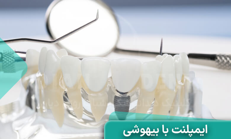 ایمپلنت با بیهوشی چگونه است