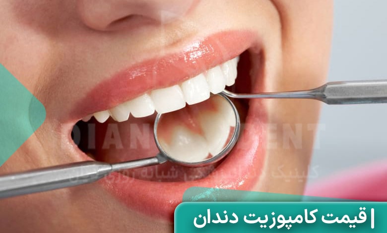 قیمت کامپوزیت قسطی چقدر است؟