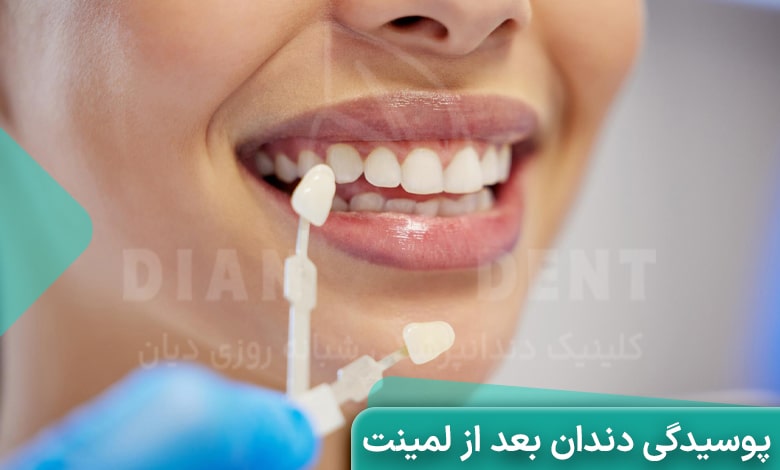 پوسیدگی دندان بعد از لمینت