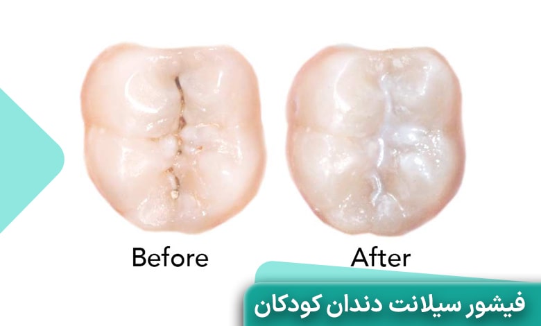 عکس قبل و بعد از فیشور سیلانت دندان