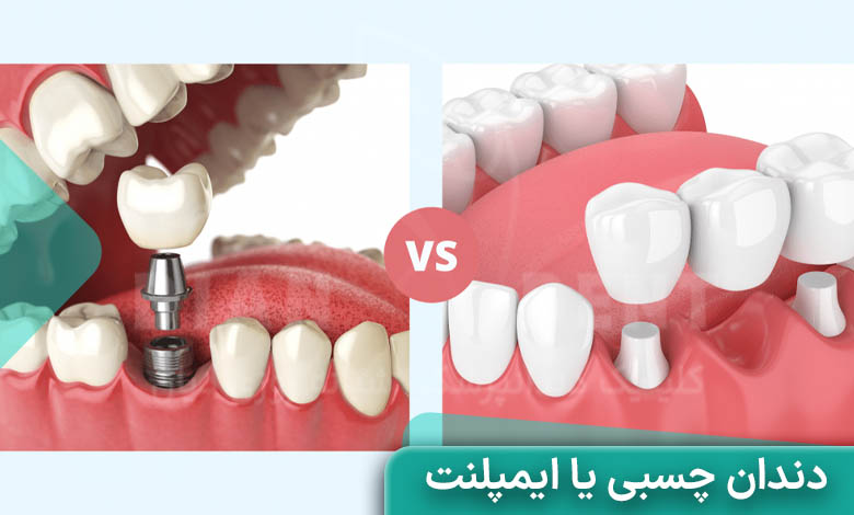 دندان چسبی بهتر است یا ایمپلنت