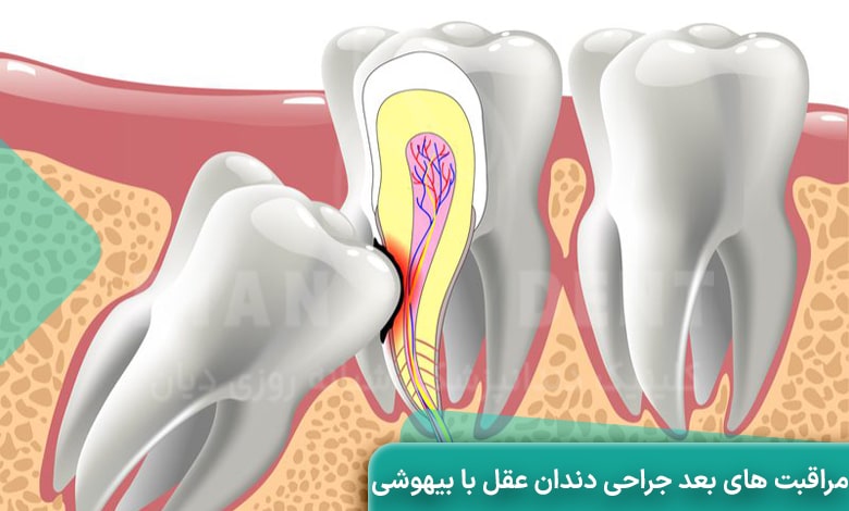 مراقبت های بعد از جراحی دندان عقل با بیهوشی