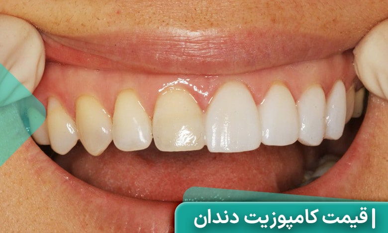 عوامل موثر بر قیمت کامپوزیت دندان