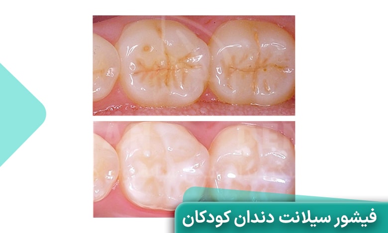فیشور سیلانت دندان کودکان