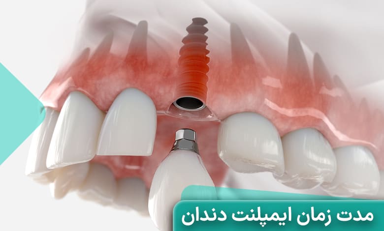 ایمپلنت دندان چقدر طول میکشد