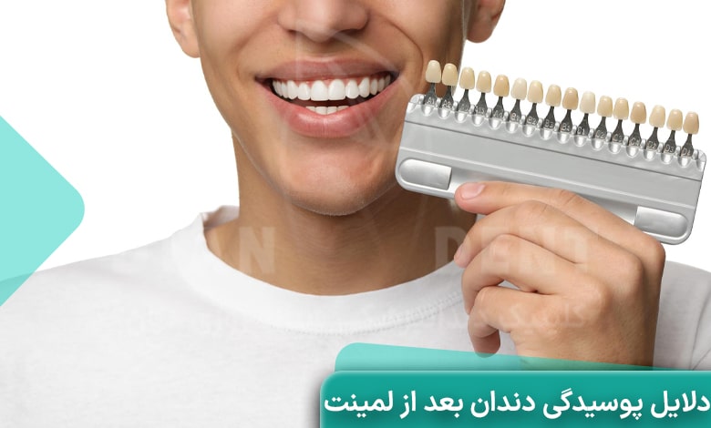 دلایل پوسیدگی دندان بعد از لمینت چیست