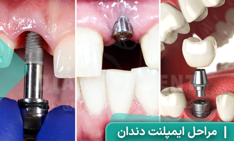 مراحل اصلی ایمپلنت دندان