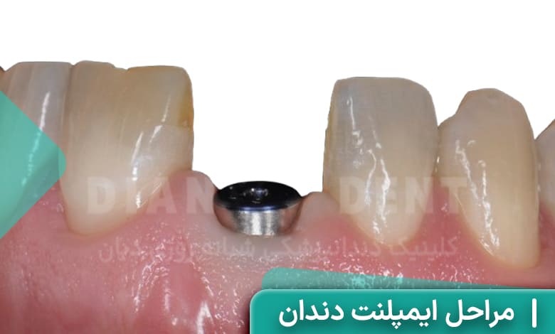 مراحل ایمپلنت دندان