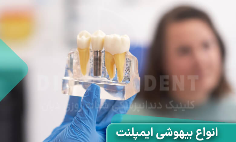 انواع بیهوشی برای ایمپلنت