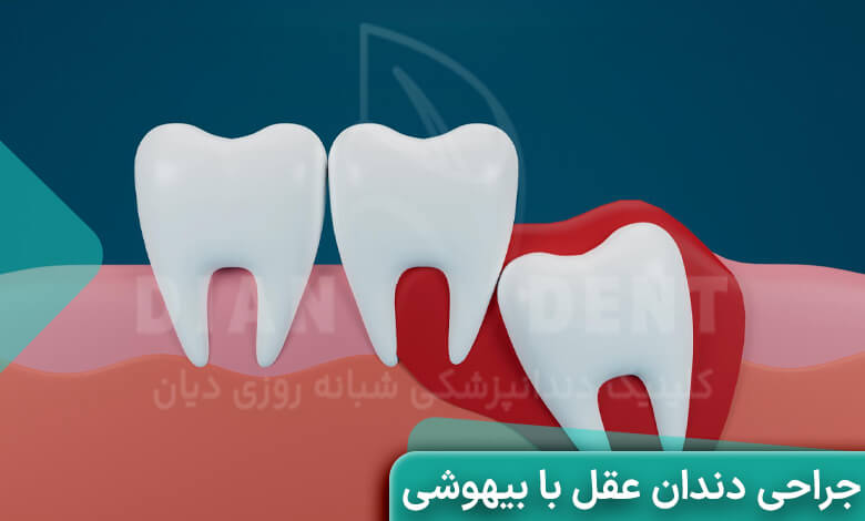 مراحل جراحی دندان عقل با بیهوشی