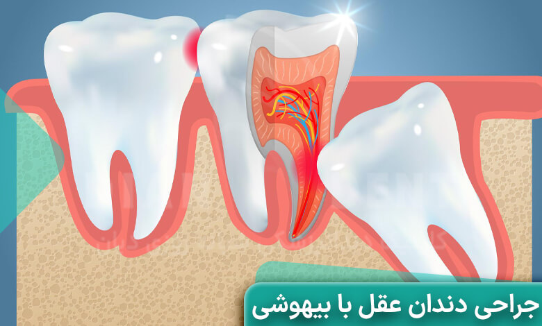 جراحی دندان عقل با بیهوشی + مراحل و عوارض آن