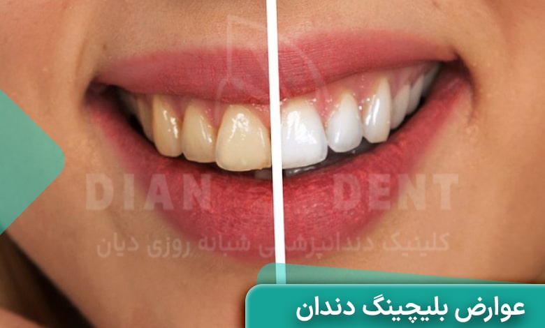 عوارض بلیچینگ دندان چیست