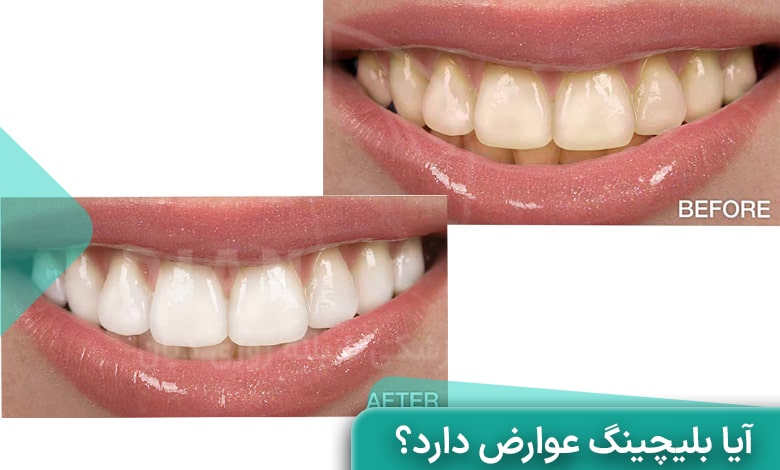 آیا بلیچینگ دندان عوارض دارد