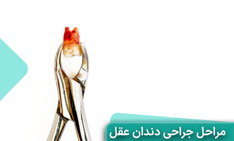 مراحل جراحی دندان عقل
