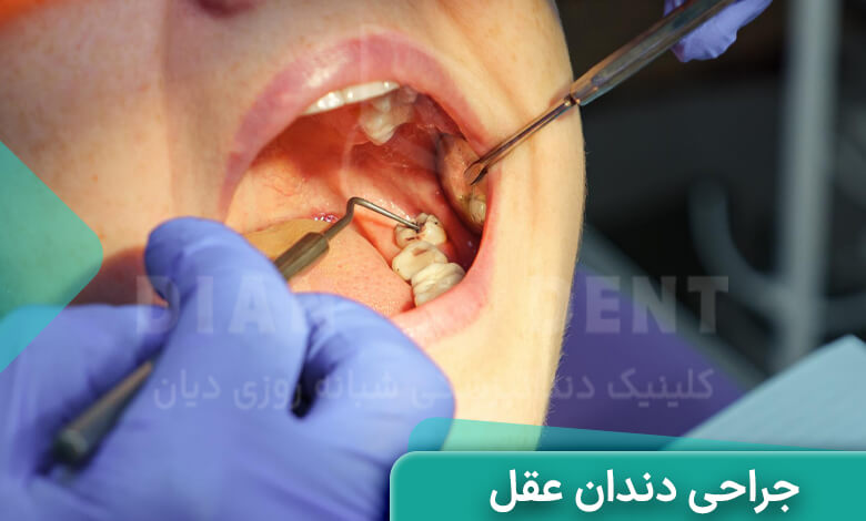 جراحی دندان عقل چیست
