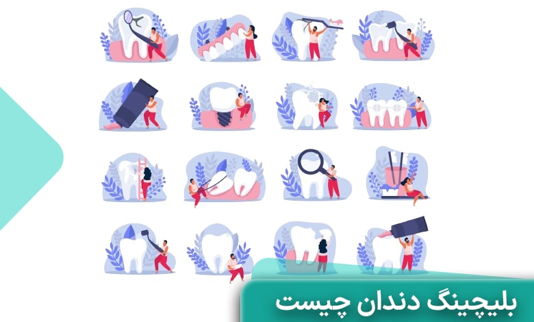 مزایای بلیچینگ دندان