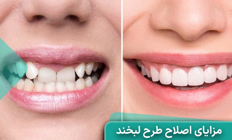 مزایای اصلاح طرح لبخند چیست؟