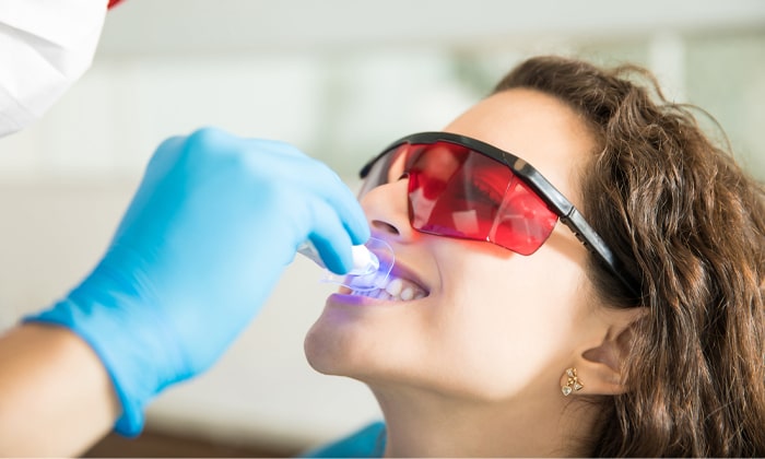 بلیچینگ دندان