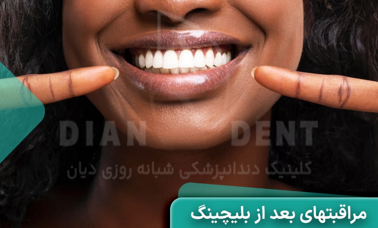 مهم ترین مراقبت های بعد از بلیچینگ دندان