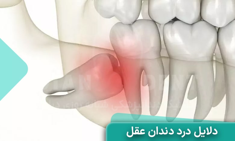 دلایل درد دندان عقل چیست