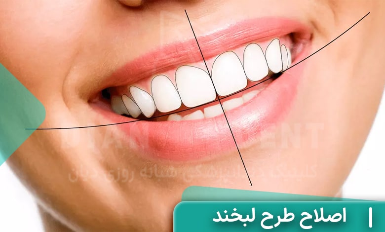 اصلاح طرح لبخند