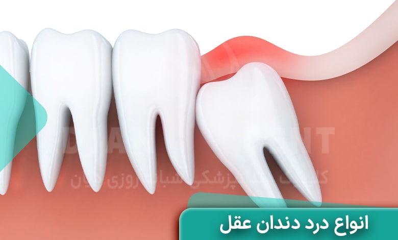 انواع درد دندان عقل