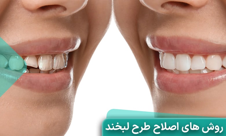 روشهای اصلاح طرح لبخند