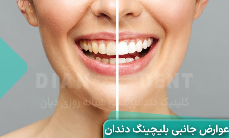 لیست عوارض جانبی بلیچینگ دندان