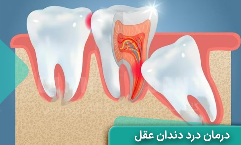 روش های درمان درد دندان عقل