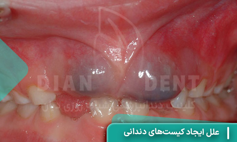 علل ایجاد کیست‌های دندانی