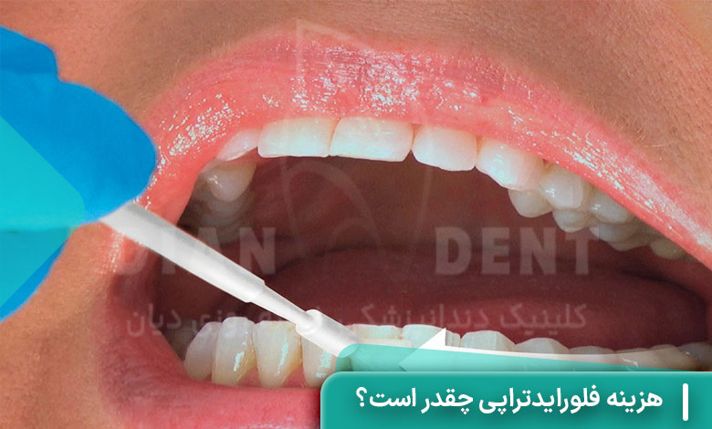 هزینه فلورایدتراپی چقدر است؟