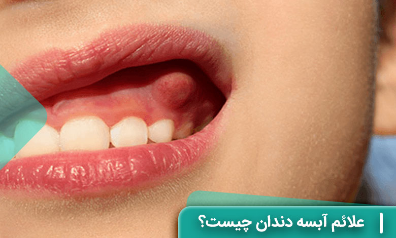 علائم آبسه دندان چیست؟