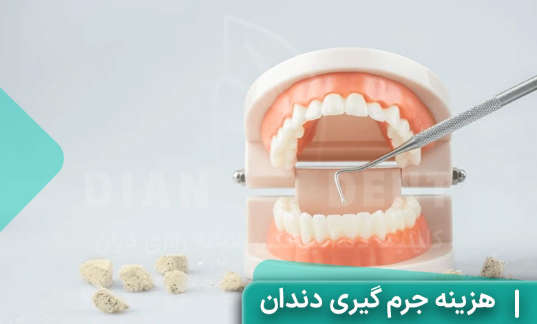 هزینه جرم گیری دندان