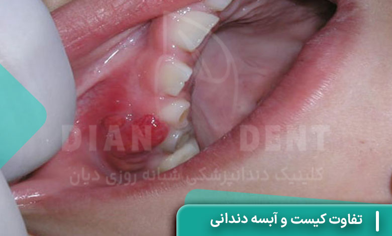 تفاوت کیست و آبسه دندانی