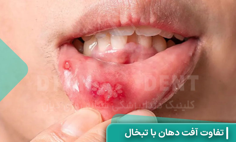 تفاوت آفت دهان با تبخال