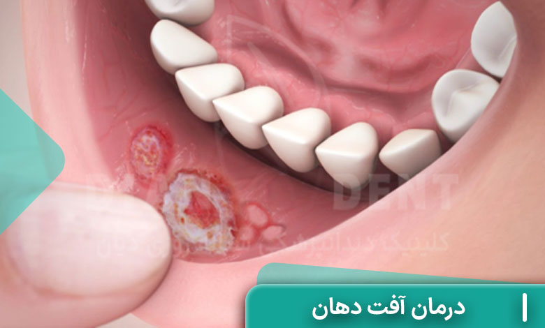درمان آفت دهان