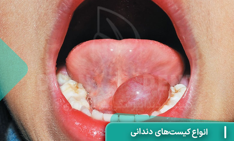 انواع کیست‌های دندانی