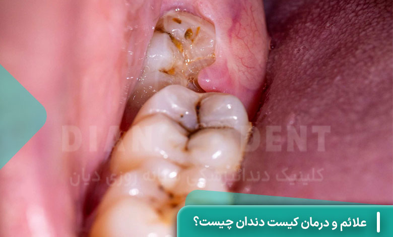 علائم و درمان کیست دندان چیست؟