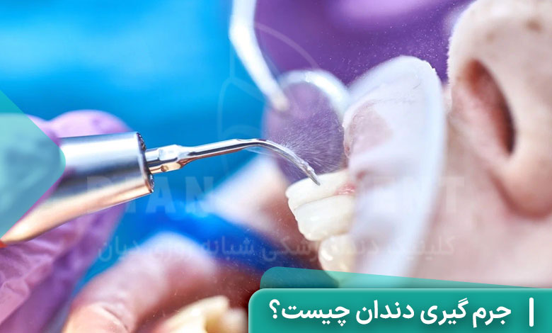 جرم گیری دندان چیست؟