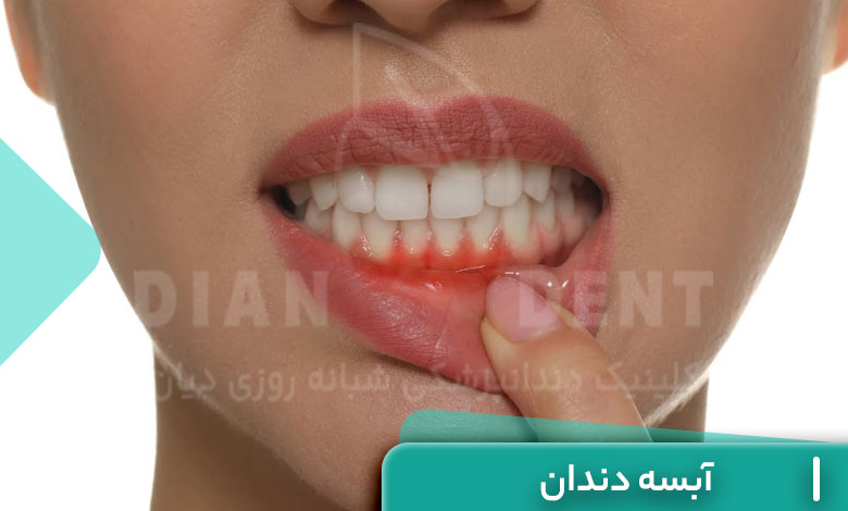 آبسه دندان