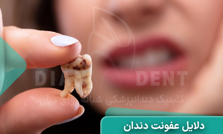 دلایل عفونت دندان چیست؟