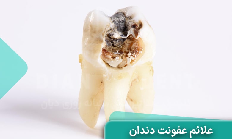 علائم عفونت دندان