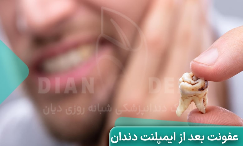 عفونت دندان بعد از ایمپلنت