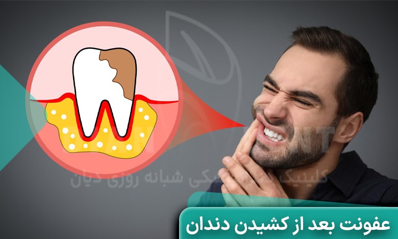 عفونت دندان بعد از کشیدن