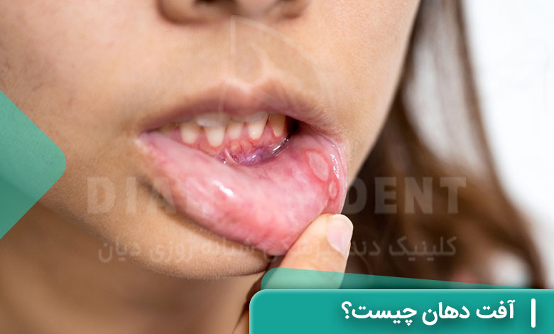 عکس آفت دهان داخل دهان پشت لب پایین
