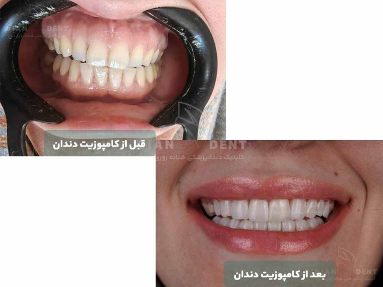 نمونه کار قبل و بعد کامپوزیت دندان 1